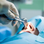 Chirurgia plastyczna: Jak przebiega operacja nosa?