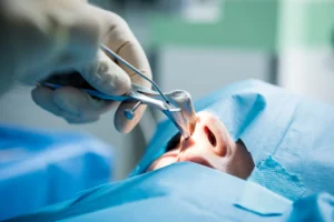 Chirurgia plastyczna: Jak przebiega operacja nosa?